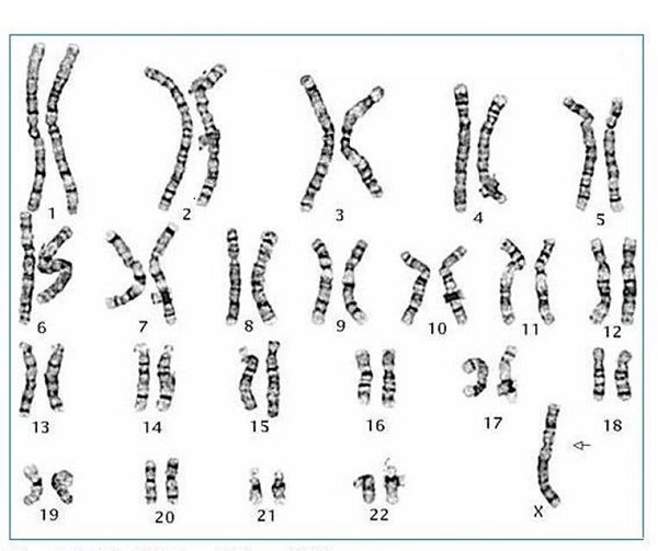¿Qué es el Síndrome de Turner? Retrato de mujeres afectadas y sus familias