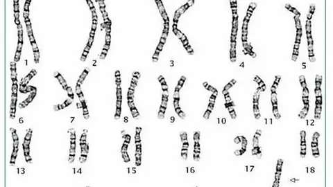 ¿Qué es el Síndrome de Turner? Retrato de mujeres afectadas y sus familias