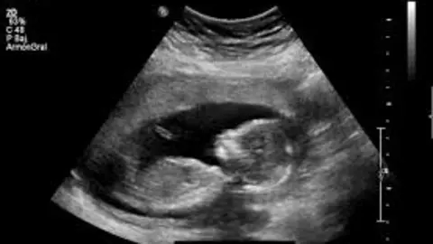 Ecografía de un bebé